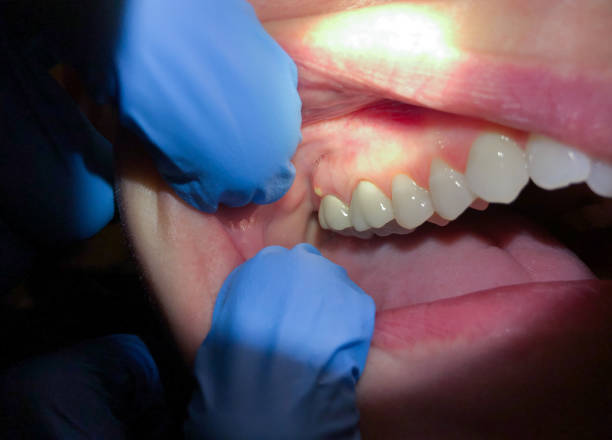 Best Tooth Infection Emergency Dentist  in Southern Pines, NC